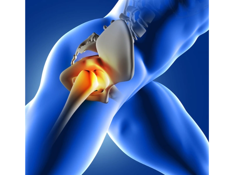 Hip Replacement Surgery in Indore