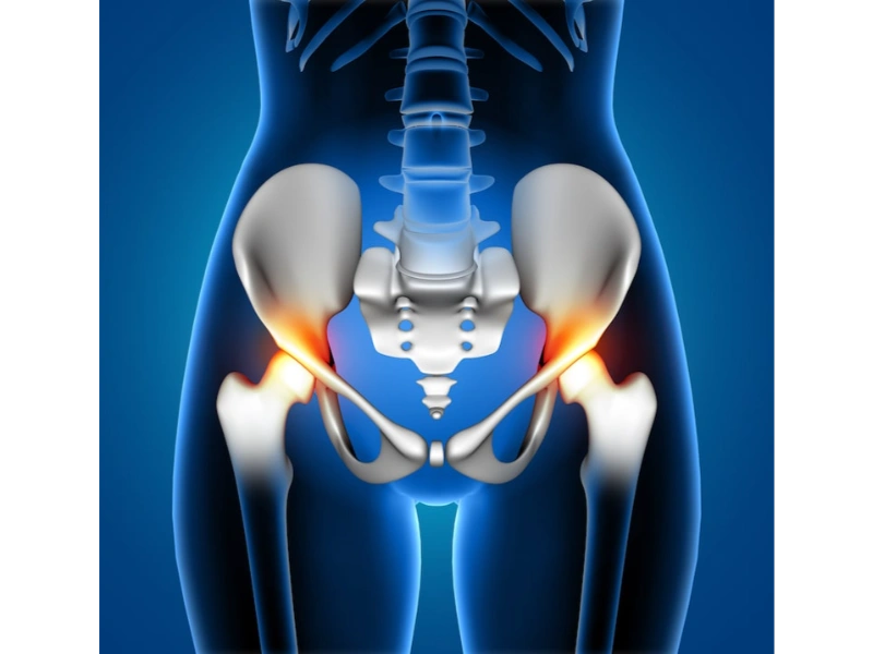 Revision Hip Replacement Surgery in Indore