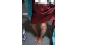 Successful Total Knee Replacement Surgery for a 53-Year-Old Woman with Severe Pain in Both Knees