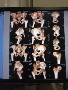 Successful Total Hip Replacement for Neglected Post-Traumatic Acetabular Fracture