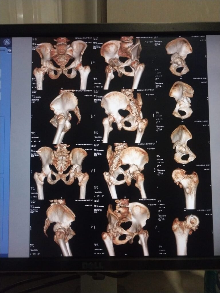Successful Total Hip Replacement for Neglected Post-Traumatic Acetabular Fracture