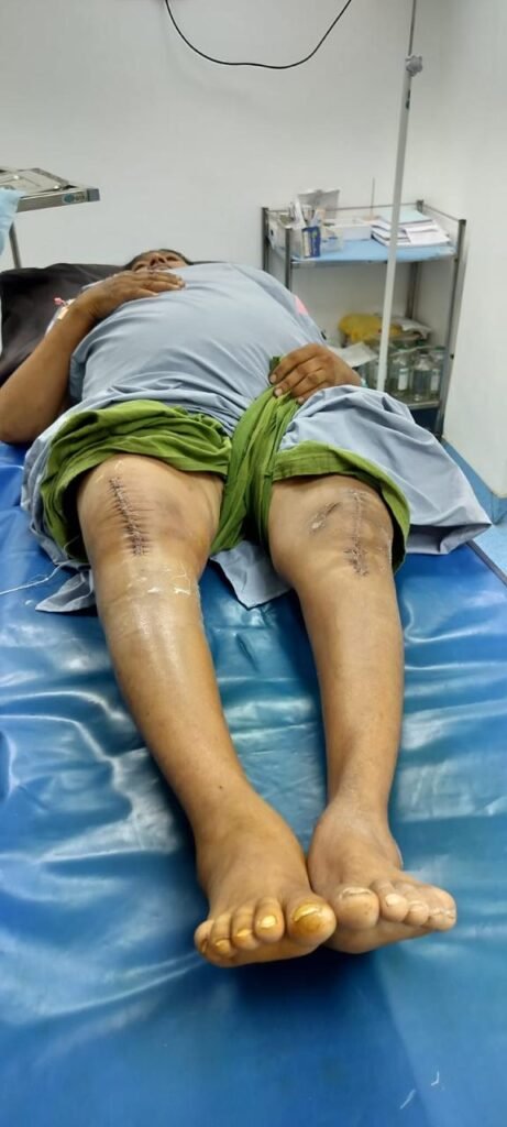 A New Beginning After 12 Years: Bilateral Total Knee Replacement Success