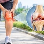 Knee Arthritis Pain