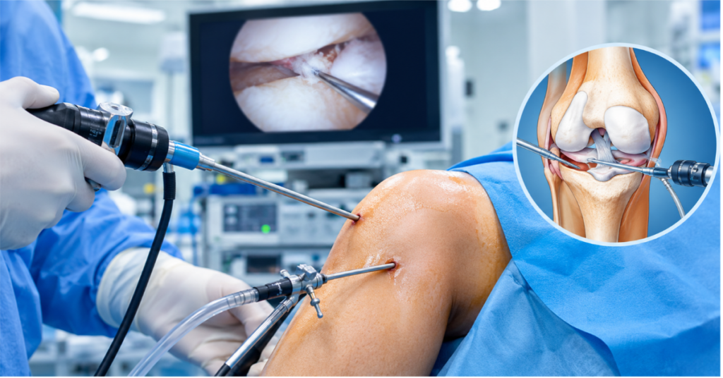 Knee Arthroscopy Surgery in Indore