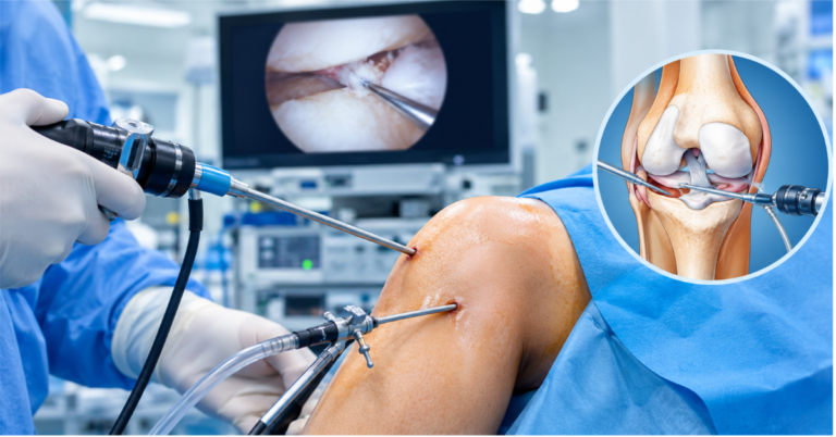 Knee Arthroscopy Surgery in Indore